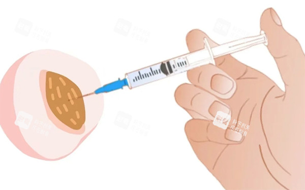私密注射紧缩针照片