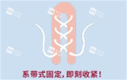 再生阴道紧缩术