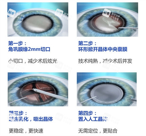 晶体置换手术过程