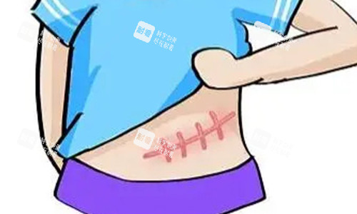 腹部疤痕增生的动画图