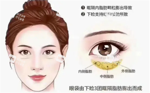 眼袋详细介绍动画图