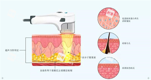 超声炮原理