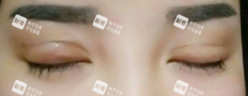 双眼皮失败照片