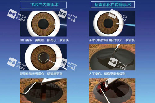飞秒白内障和超声乳化白内障