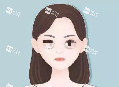 泪沟漫画示意图