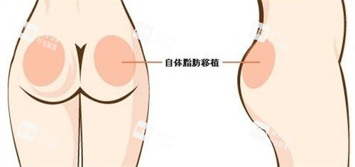 自体脂肪丰臀