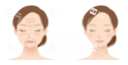 热玛吉提升前后对比