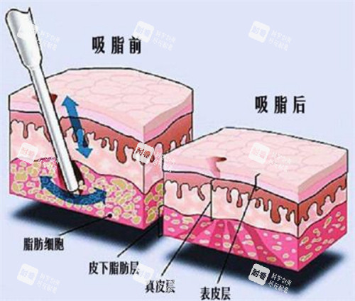 吸脂手术前后对比动画图示