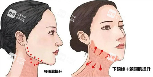 提升下颌线