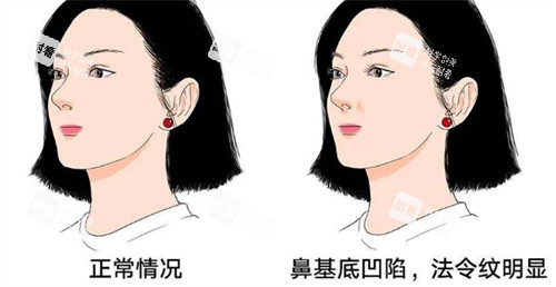 正常鼻基底和凹陷鼻基底