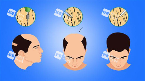 男性毛发移植对比动画图