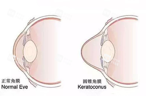 圆锥角膜与正常眼睛展示图
