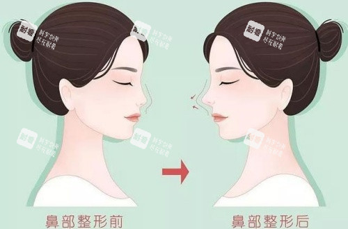 隆鼻术后漫画示意图