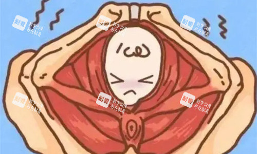 缩阴手术卡通图