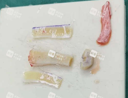 肋骨隆鼻材料