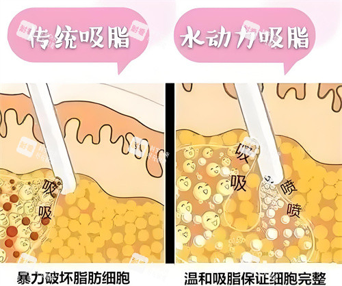 负压吸脂和水动力吸脂方式对比动画图