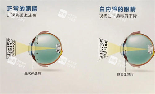 正常眼睛和白内障眼睛的对比图