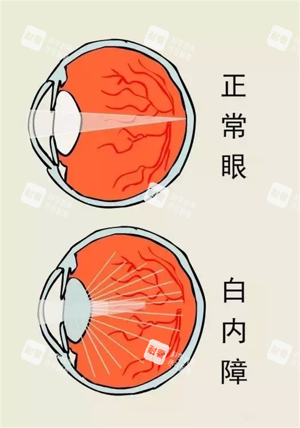 正常眼睛和白内障眼睛区别