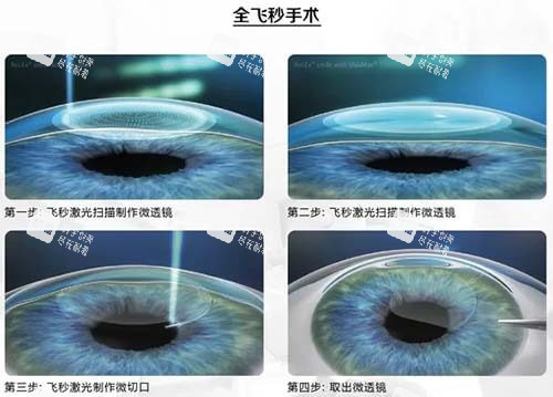 近视眼手术4