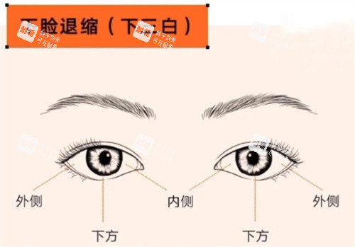 眼修复下睑退缩