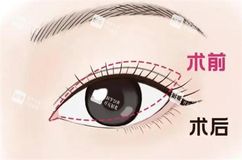 双眼皮修复手术对比