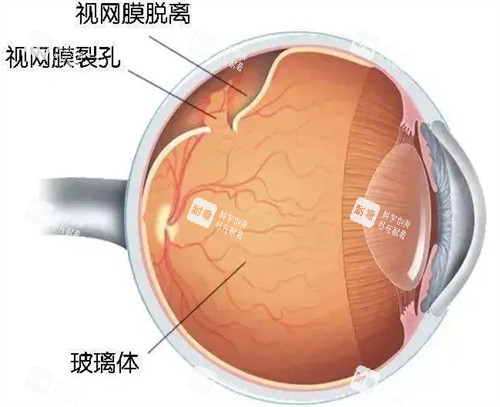 视网膜裂孔激光手术后还会裂孔吗?术后复发概率解析,这些注意事项要牢记!