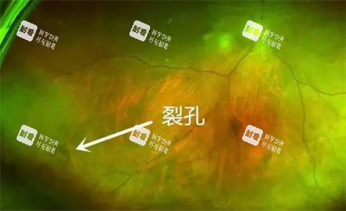 孔源性视网膜脱离裂孔部位