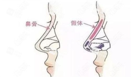 隆鼻手术示意图