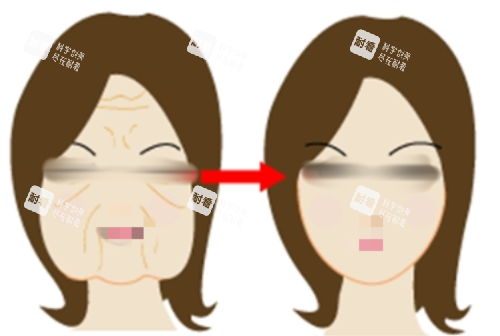 拉皮前后明显对比图