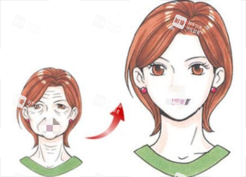 拉皮手术前后对比图