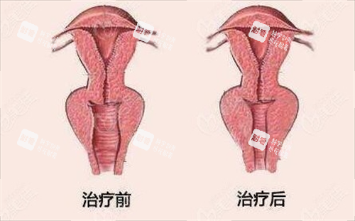 女性阴道紧缩手术前后对比动画图
