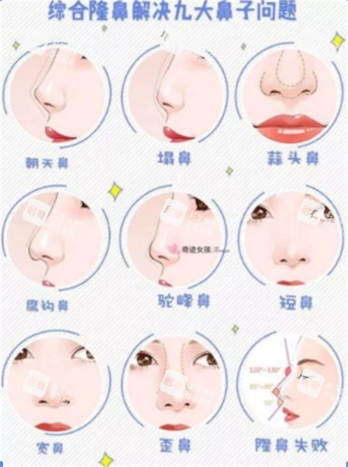 隆鼻