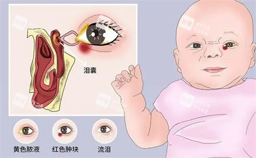 儿童泪道阻塞