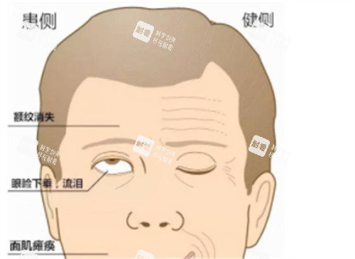 眼睑闭合不全现象
