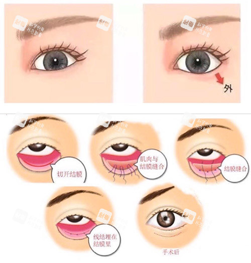 眼睑下至手术过程图