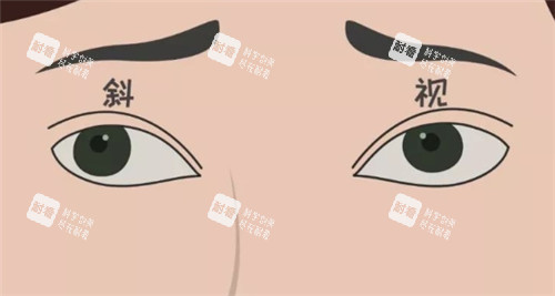 斜视眼珠表现图