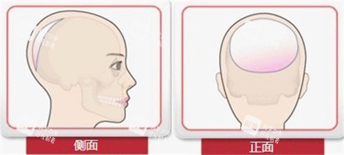 后脑勺整形手术