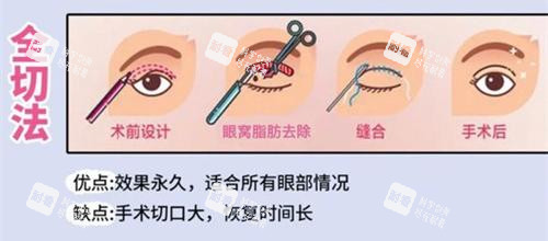 双眼皮手术全切法动画演示图