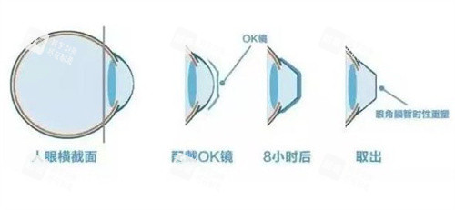 佩戴OK镜的原理