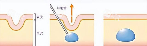 菲林普利针
