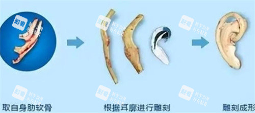 耳再造肋软骨雕刻成型的过程