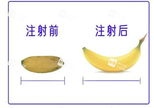 丁丁打玻尿酸前后对比