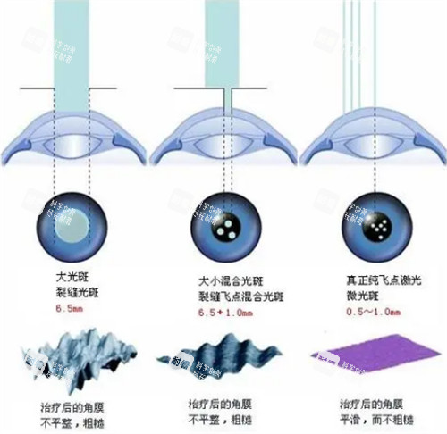 近视手术对比