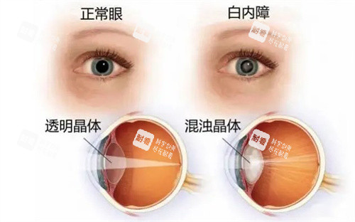 正常眼白内障的区别