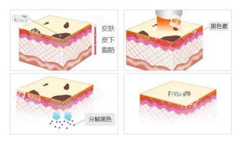 激光去痣过程