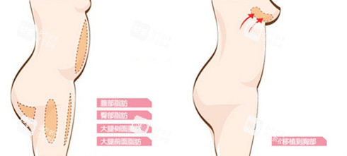 自体脂肪隆胸图