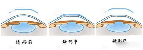 晶体植入矫正近视前中后漫画示意图