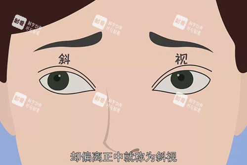 眼睛斜视卡通图展示