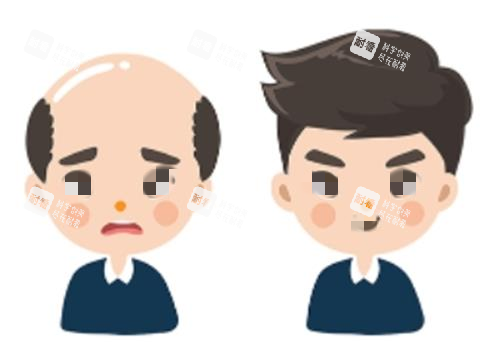 植发前后对比示意图