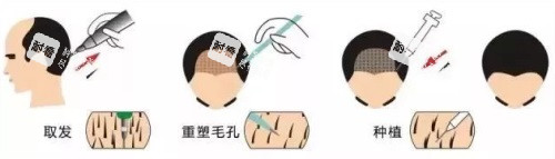 植发过程图